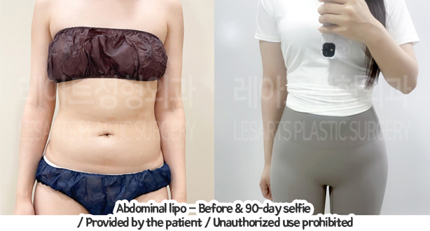 abdominal_liposuction_02_01_240119