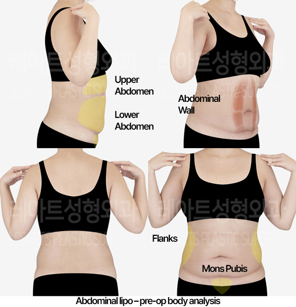 abdominal_liposuction_02_01_240430