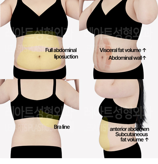 abdominal_liposuction_02_01_240529