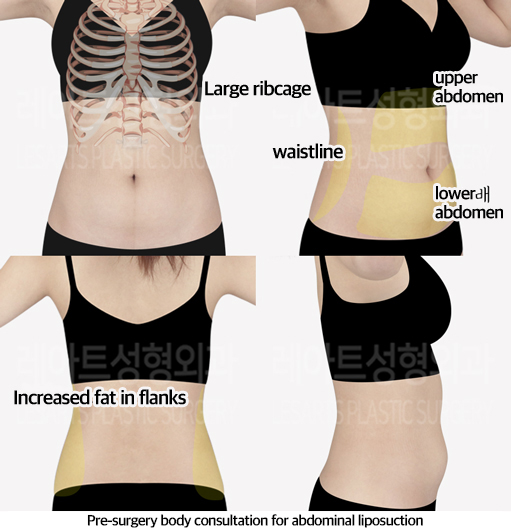 abdominal_liposuction_02_01_240604