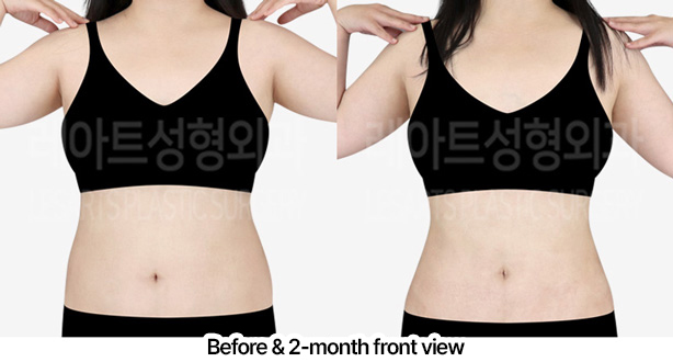 abdominal_liposuction_02_02_230227