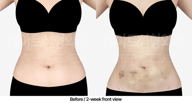 abdominal_liposuction_02_02_230306
