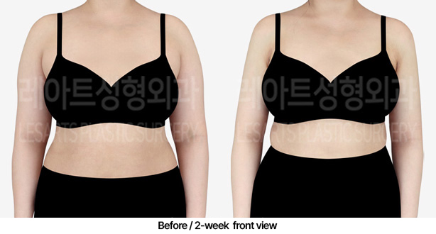 abdominal_liposuction_02_02_2303072