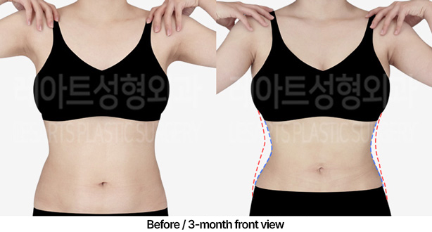 abdominal_liposuction_02_02_230409