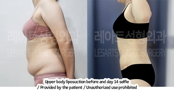 abdominal_liposuction_02_02_240105