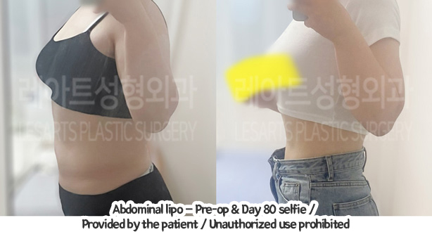 abdominal_liposuction_02_02_240110