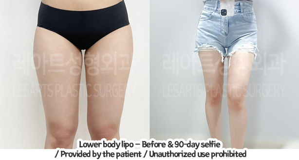 abdominal_liposuction_02_02_240119
