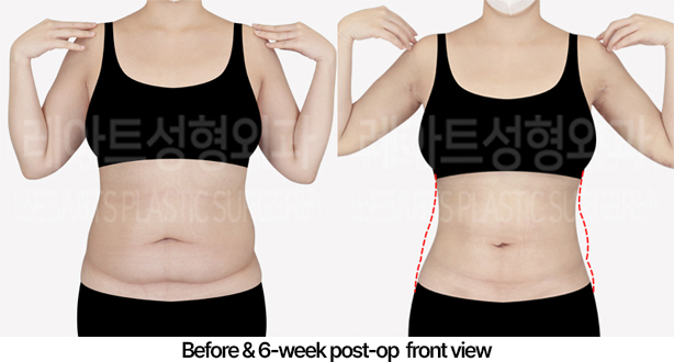 abdominal_liposuction_02_02_240430