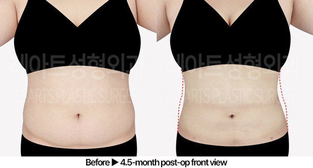 abdominal_liposuction_02_02_240529