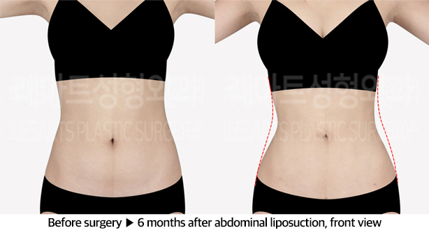 abdominal_liposuction_02_02_240604