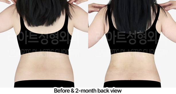 abdominal_liposuction_02_03_230227