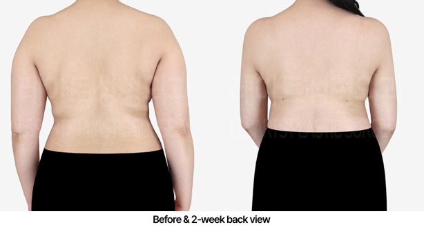 abdominal_liposuction_02_03_2303072