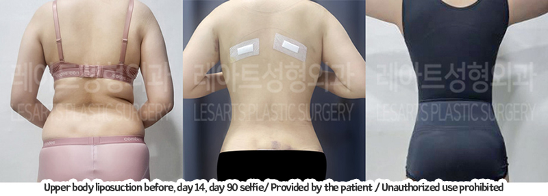 bdominal_liposuction_02_03_240105