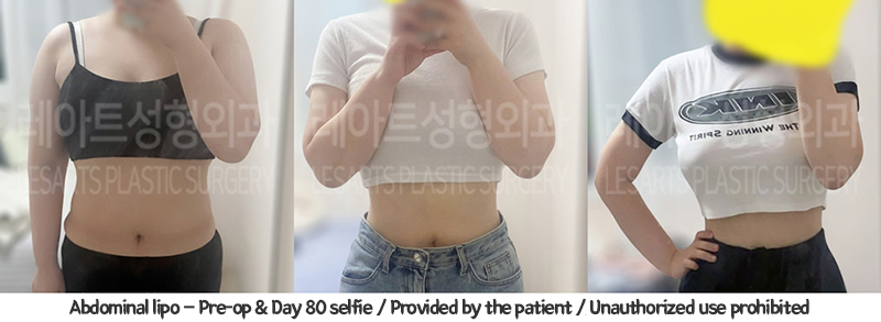 abdominal_liposuction_02_03_240110