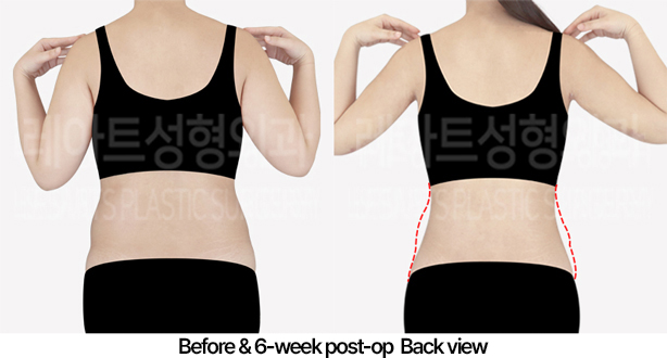 abdominal_liposuction_02_03_240430