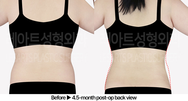 abdominal_liposuction_02_03_240529