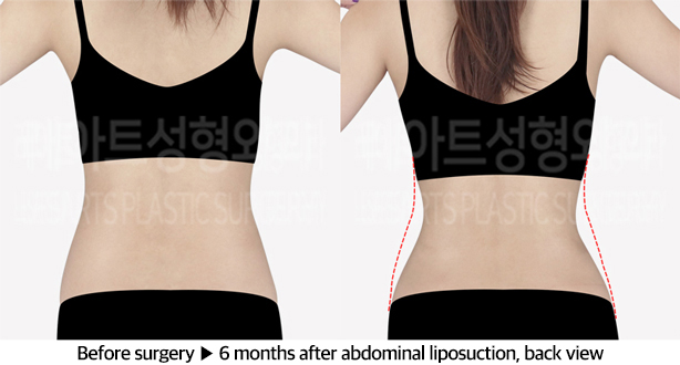 abdominal_liposuction_02_03_240604