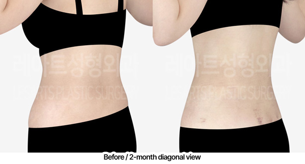 abdominal_liposuction_02_04_230306