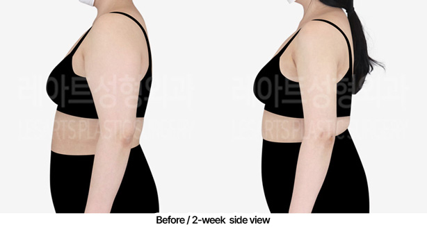 abdominal_liposuction_02_04_2303072