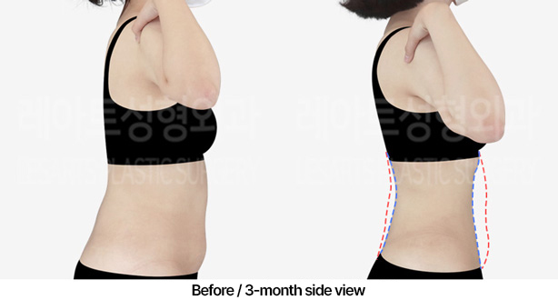 abdominal_liposuction_02_04_230409