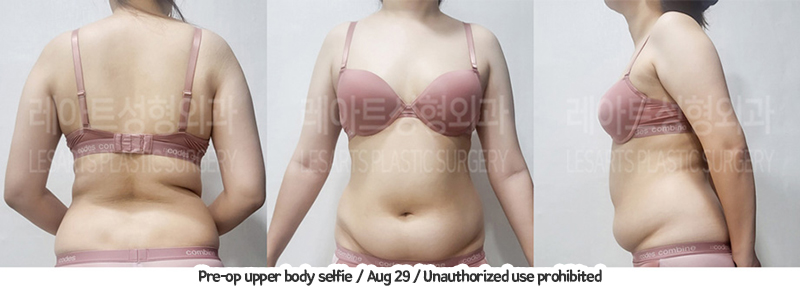 abdominal_liposuction_02_04_240105