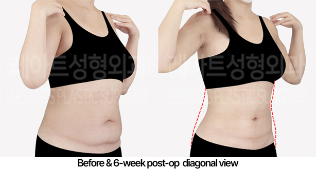 abdominal_liposuction_02_04_240430