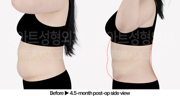 abdominal_liposuction_02_04_240529