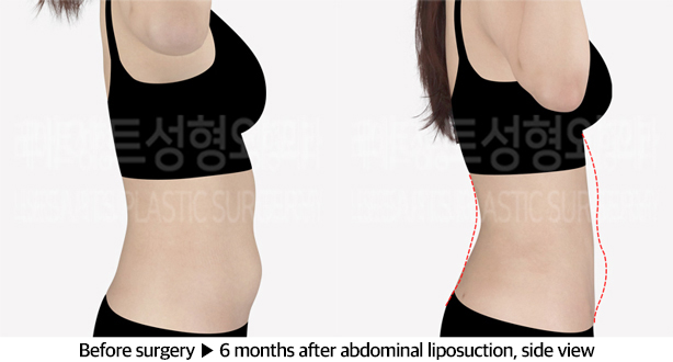 abdominal_liposuction_02_04_240604