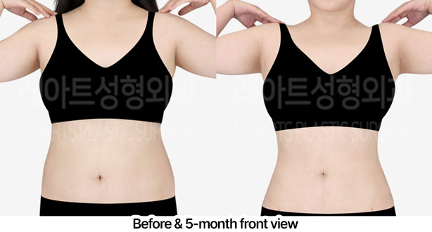 abdominal_liposuction_02_05_230227