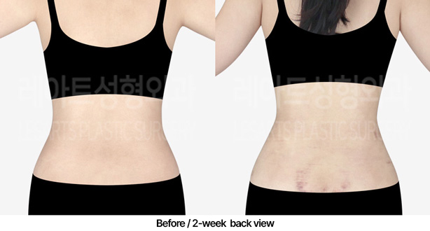 abdominal_liposuction_02_05_230306