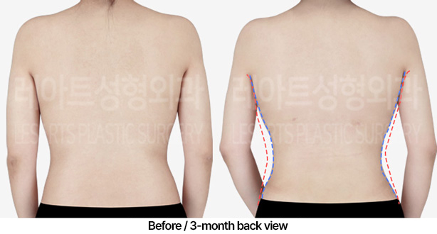 abdominal_liposuction_02_05_230409