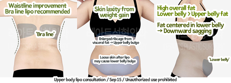 abdominal_liposuction_02_05_240105