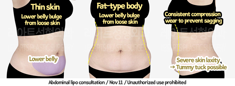 abdominal_liposuction_02_05_240110