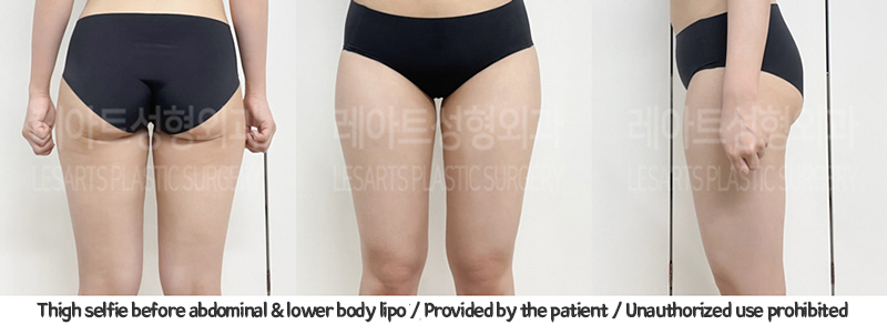 abdominal_liposuction_02_05_240119