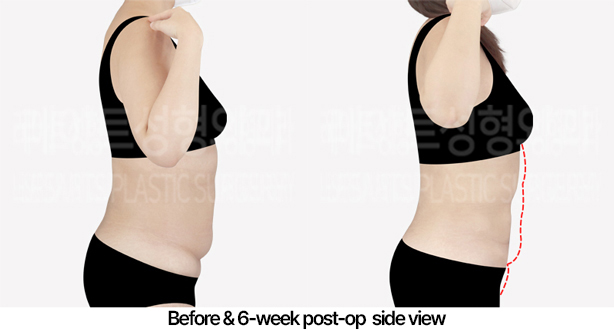 abdominal_liposuction_02_05_240430