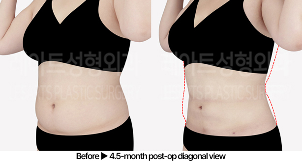 abdominal_liposuction_02_05_240529