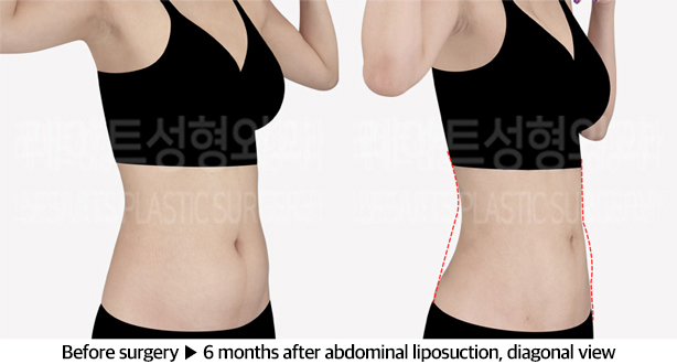 abdominal_liposuction_02_05_240604