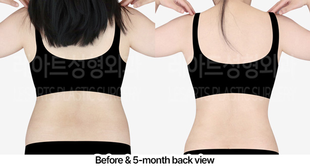 abdominal_liposuction_02_06_230227