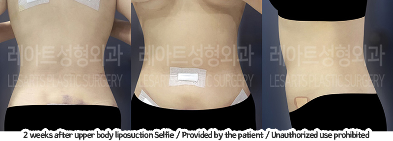 abdominal_liposuction_02_06_240105