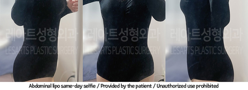 abdominal_liposuction_02_06_240110