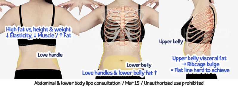 abdominal_liposuction_02_06_240119