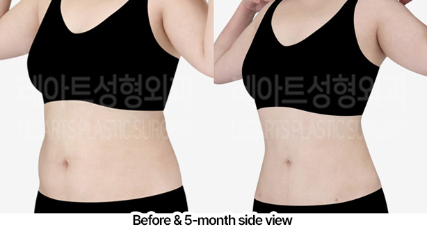 abdominal_liposuction_02_07_230227