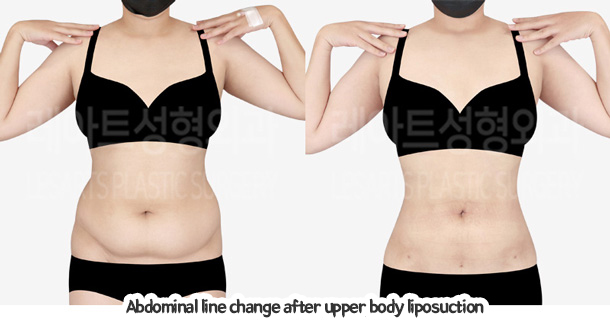 abdominal_liposuction_02_07_240105