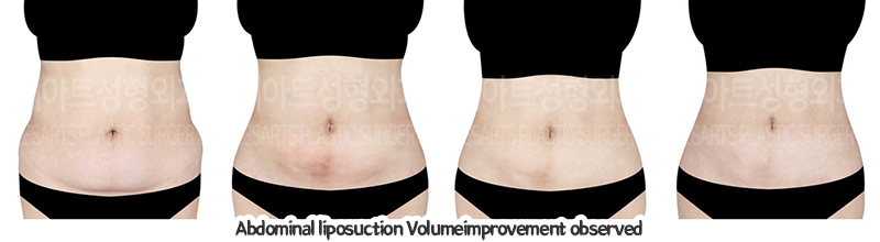 abdominal_liposuction_02_07_240110