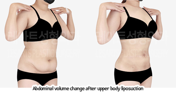 abdominal_liposuction_02_08_240105