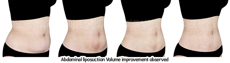 abdominal_liposuction_02_08_240110