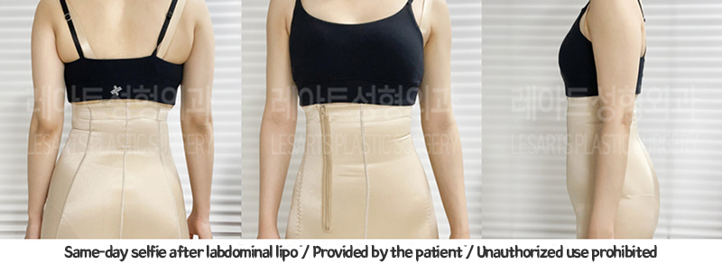 abdominal_liposuction_02_08_240119