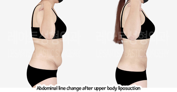 abdominal_liposuction_02_09_240105