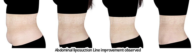 abdominal_liposuction_02_09_240110