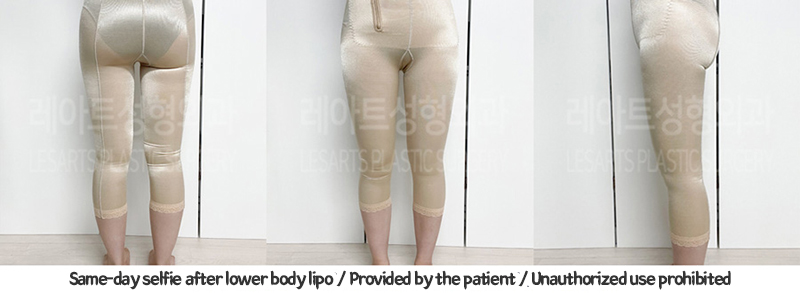 abdominal_liposuction_02_09_240119